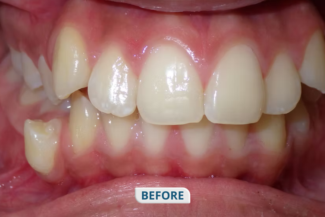 Before treatment at Namira Oro Dental Care